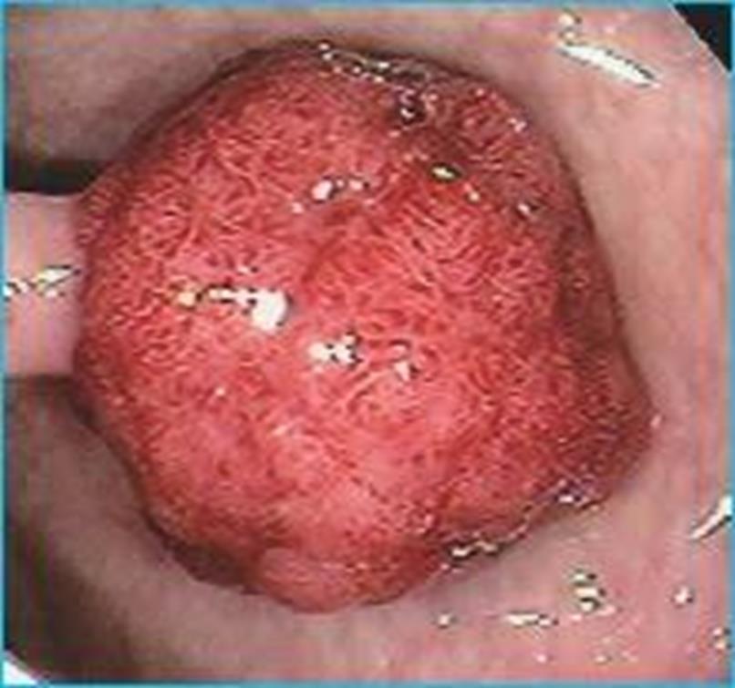 Introduction Advanced Polyp or Lesion What