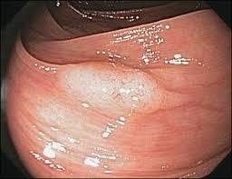 Pro Colonoscopy - Sessile Serrated Polyps Approximately 20-30% of CRC felt to arise from