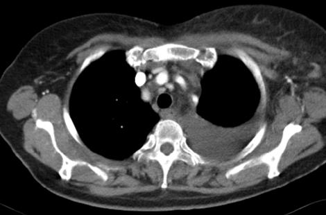 199 Gastric Signet-Ring Cell Carcinoma: Unilateral Lower Extremity Lymphoedema as the Presenting Feature FIGURE 2.
