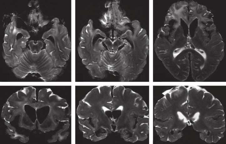 Focal and faint hyperintensities are seen in the subcortical white matter in the anteromedial part of the right temporal lobe (arrowheads in E).