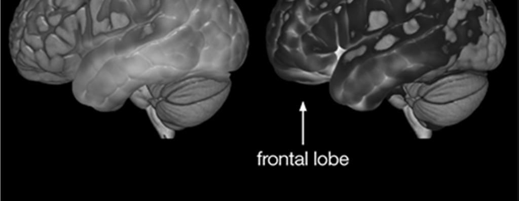 Adapted from Benson and Stuss (1986) PIRAMIDAL CELL CELL SPINDLE Location: Anterior cingulate cortex and Fronto-insular cortex and dorsolateral prefrontal cortex.