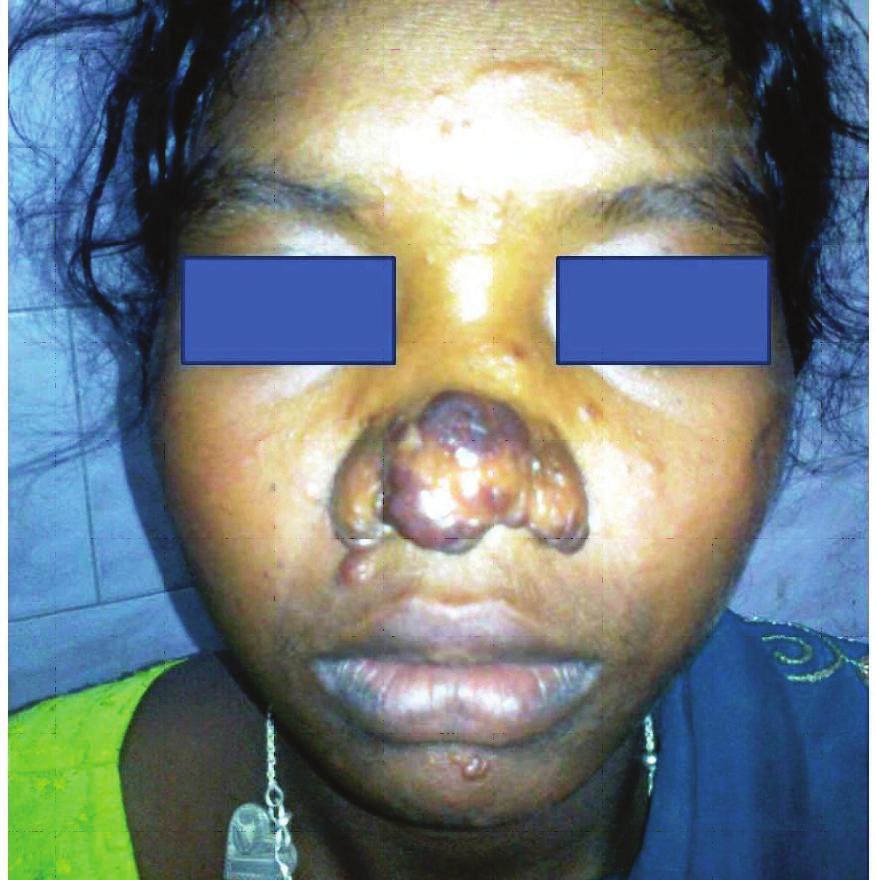 156 A Rare Case of Cutaneous Leishmaniasis Presenting as Rhinophyma Case Report A 20 year old female from Birbhum district (West Bengal), India, presented with soft painless swelling of her nose