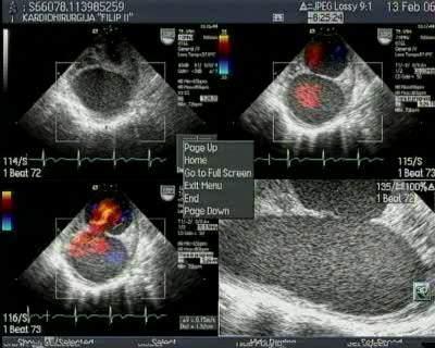 Echocardiography The distal thoracic and the proximal abdominal aorta, just