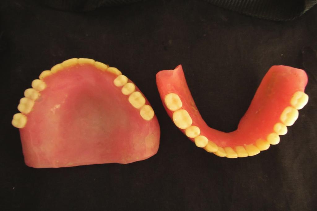 2 Case Reports in Dentistry Figure 1: Patient s old denture. Figure 3: Vacuum heat-pressed polyethylene sheet (1.5 mm thick). Figure 2: Final impression made with elastomeric impression material.