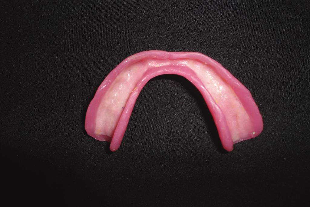 Case Reports in Dentistry Figure 5: Polished denture with 1.5 mm thick temporary polyethylene sheet. Figure 6: Intraoral view of maxillary and mandibular complete dentures.