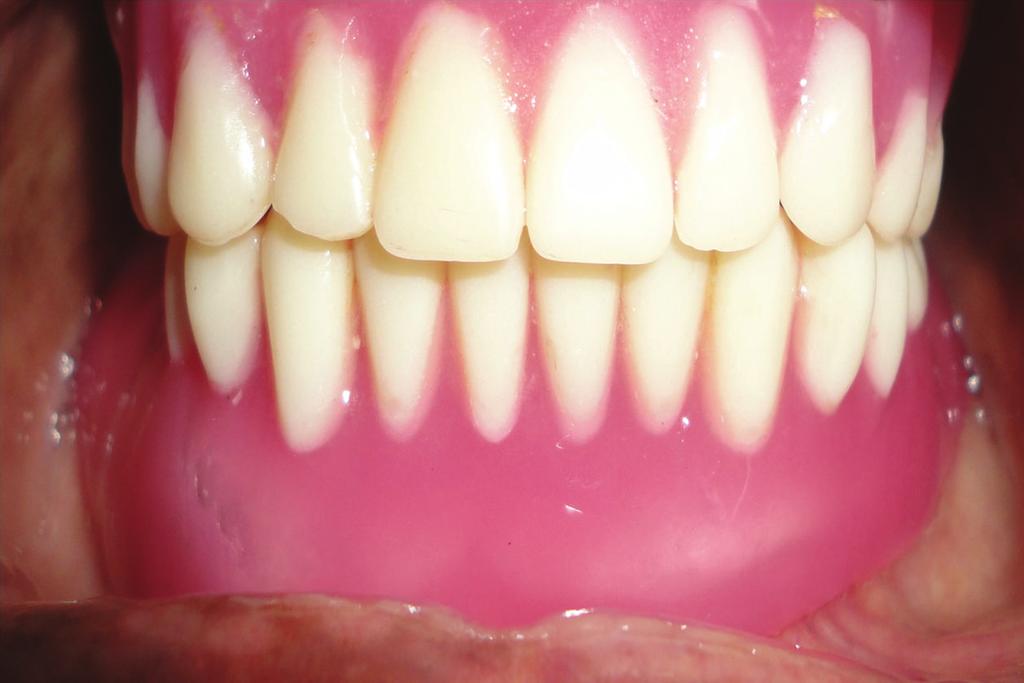 Discussion was used in place of 1.5 mm thick sheet creating a 1 mm space between tissue surface of the denture and permanent polyethylene sheet (Figure 7).