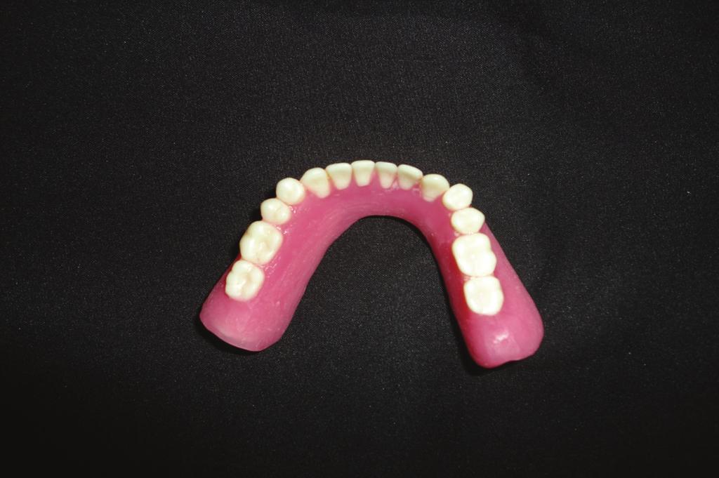 4 Case Reports in Dentistry Figure 9: Final mandibular denture (Polished surface).