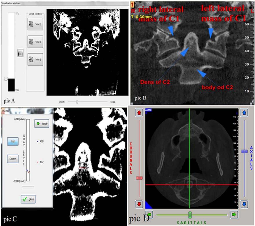 Cervical Vertebrae Density Value for Osteoporosis/Osteopenia 191 surement method of Spin-Neto et al, 23 indicated high homogeneity in scan densities.