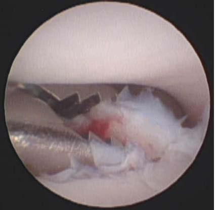 Recovery, especially from arthroscopic surgery, tends to be reasonably rapid. Occasionally lameness fails to improve. This may be due to the underlying joint incongruency or degenerative changes.
