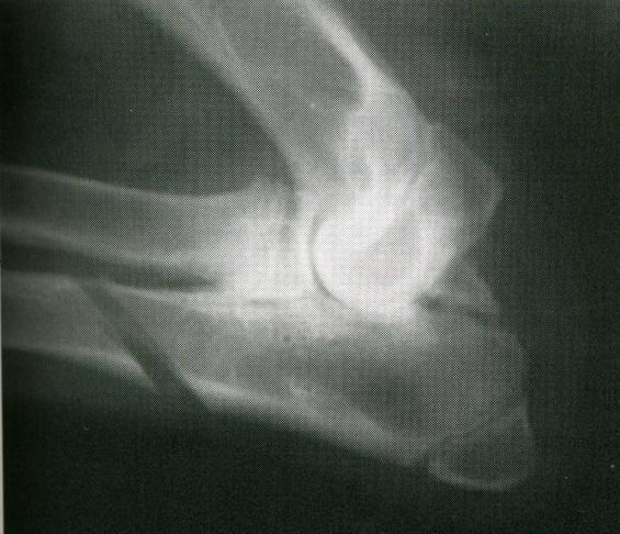 Immediate aftercare is minimal but includes the use of NSAIDS where required and exercise restriction. Ulna Osteotomy Incongruity of the elbow joint can be improved by Ulna Osteotomy.