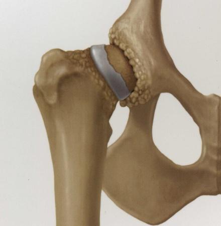 ingongruency Osteophyte production More severe degenerative changes Loss of normal