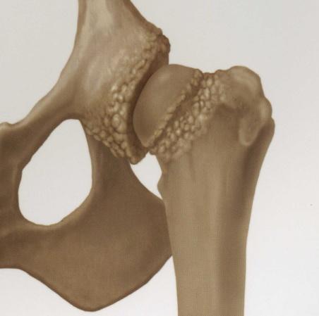 remaining Complete loss of articular cartilage Flattened acetabulum Moderate to