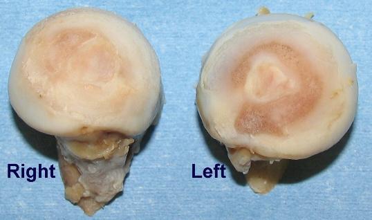 Femoral heads removed from a 6 month old GSD bitch. Note the articular cartilage damage to both heads.