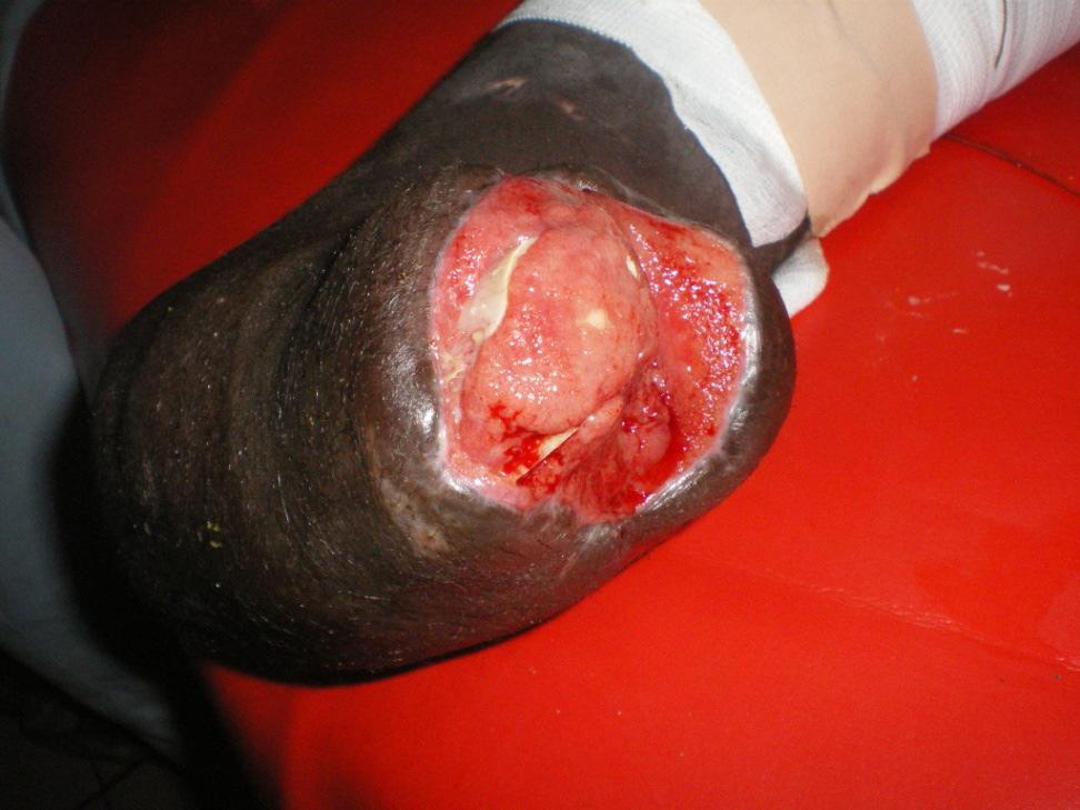 On examination the wound was about 8 5cm in the distal part of sole of the foot with pussy discharge and fibrosis of the skin edges of the ulcer. Swab culture revealed S.
