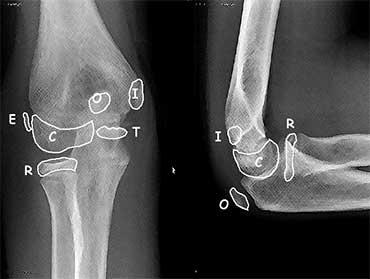 Pediatric Orthopedics 101 Radiologic Pearls: Growth plates can mimic fractures Get comparison views Ossification centers Present at birth Distal femur, proximal tibia, calcaneus and talus Elbow s