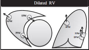 Tricuspid annuloplasty Acceptable and durable coaptation can t always be achieved using