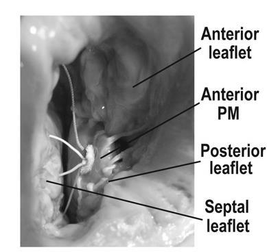 Approximating the head of the anterior papillary muscle