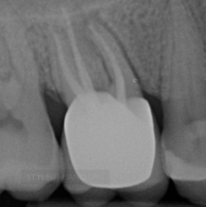 Fig. 13 Fig 13.- After 2 years under observation the patient came with pain, and was diagnosed a vertical root fracture. The tooth was extracted and substituted with an implant.