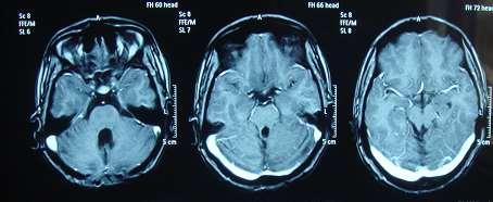 tumors, 6 years lady Headache,