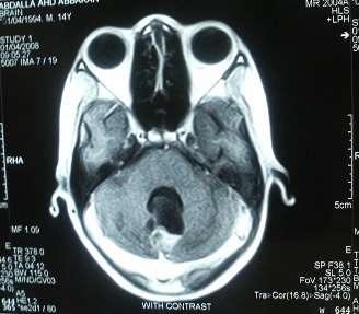 astrocytoma ) completed radiotherapy