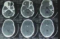 pediatric brain tumors,