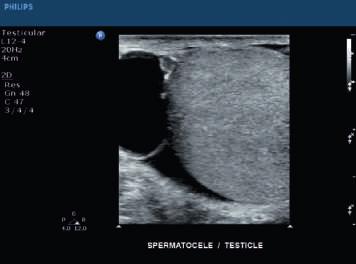 The L12-4 transducer delivers clear definition between cystic areas and