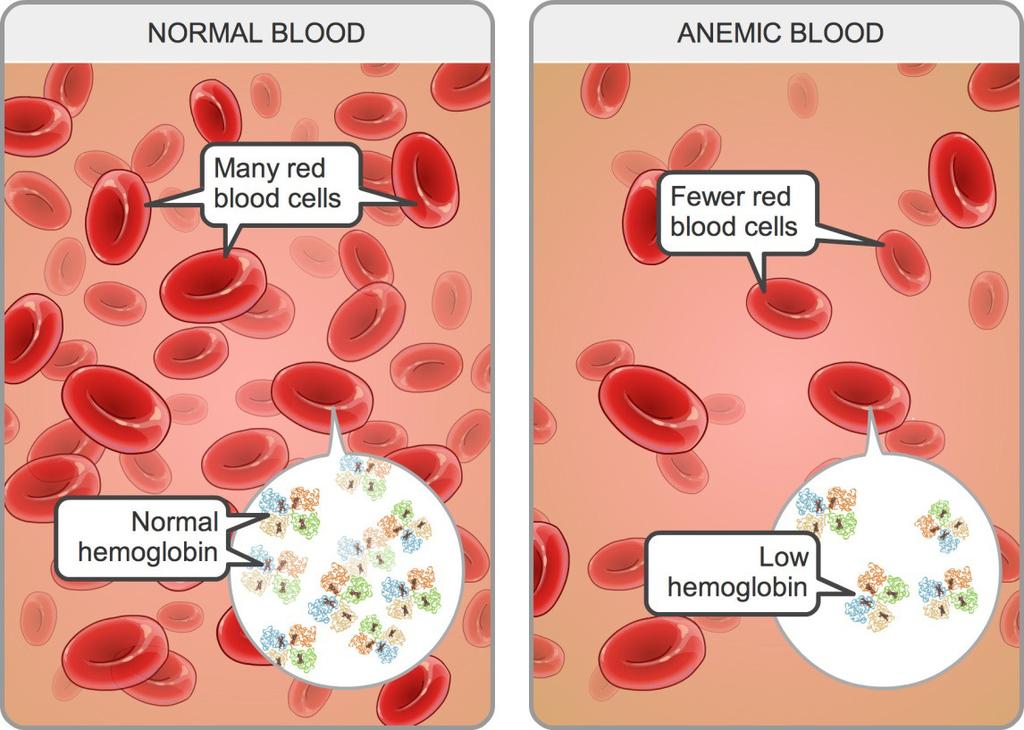 Figure (1): Normal and Anemic blood Iron deficiency anemia is diminished red blood cell production due to low iron stores in the body.