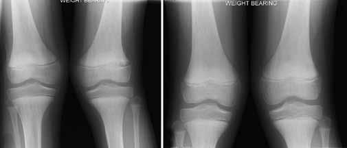0 Figure : Rdiogrph of knee joint nteroposterior view showing () distl femorl physel chnges widening of distl femorl physis nd ossifiction of metphysic with vlgus deformity in left knee t months fter