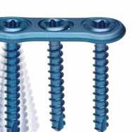 5 mm locking and non-locking screws, providing greater surgical flexibility.