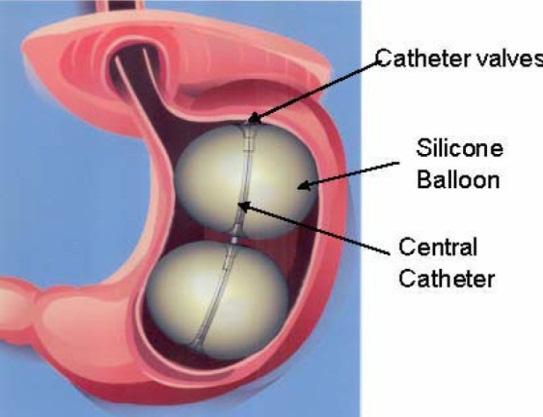 SATIETY With the capacity to hold up to 900 cc of saline, offers more gastric filling than any single