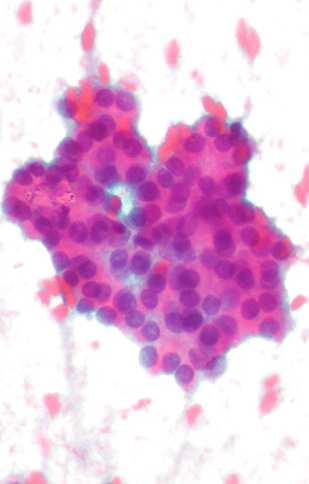EUS-FNA in NEUROENDOCRINE TUMORS Cytological evaluation of the samples