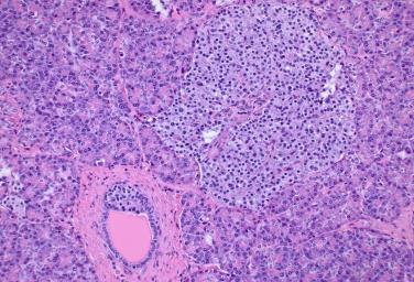An Update on Pancreas Neoplasms Arief Suriawinata, M.D.
