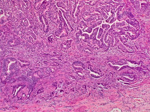 Mucinous Cystic Neoplasm (MCN) Definition: Cyst forming epithelial neoplasm that commonly does not communicate with the pancreatic ductal system, lined by mucin-producing epithelium and with