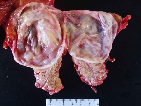 Mucinous Cystic Neoplasm Grading Old terms WHO 2010 Mucinous cystadenoma Mucinous cystic tumor, borderline Mucinous