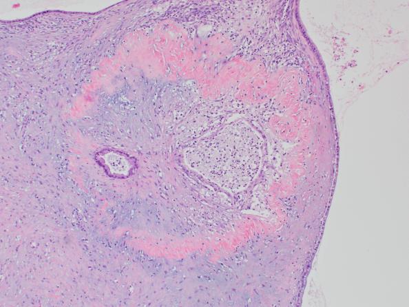 Pancreatic Neoplastic Mucinous Cysts Cytopathology Thick colloid-like extracellular mucin, or elevated CEA (>192 ng/ml), or KRAS/GNAS mutation, and/or presence of neoplastic mucinous epithelial cells