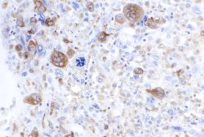 Osteoclastic Giant Cell Carcinoma CD68 Keratin Recent Developments on PDAC EUS FNA has become an