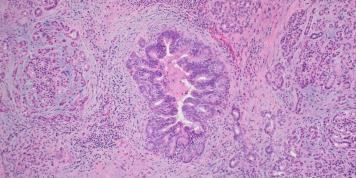 Pancreatic Carcinoma Screening High risk individuals Familial pancreatic