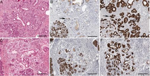 pancreatitis Identification of precursor lesions and early resectable PDAC