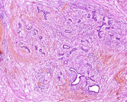 Pancreatic Neck Margins Chronic Pancreatitis Normal Pancreas Chronic Pancreatitis Variable lobules Interlobular fibrosis (absence of glands) Acinar loss Ductal changes - Reactive - Open lumen -