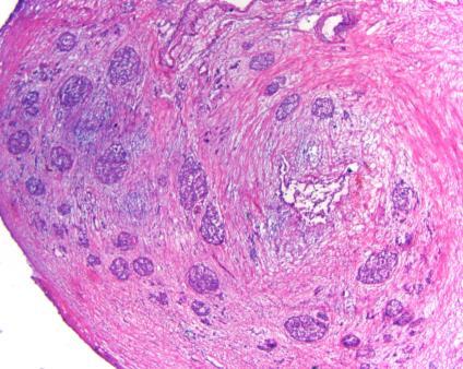 Normal Pancreas Normal Pancreas Chronic Pancreatitis Variable lobules Interlobular fibrosis (absence of glands) Acinar loss Ductal changes  changes Islets of