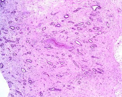 lobules Interlobular fibrosis (absence of glands)