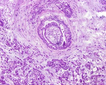 Glands in interlobular septa Growth near muscular vessels Growth near nerves