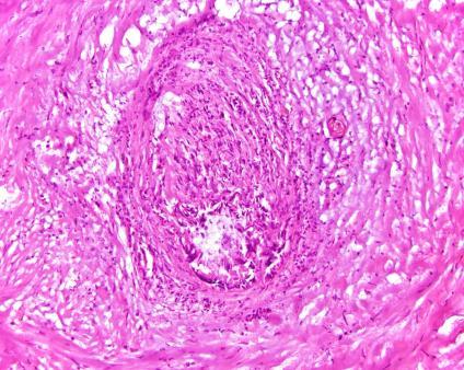Glands in interlobular septa Growth near muscular vessels