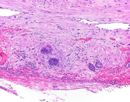 diagnosis of adenocarcinoma - pattern - Glands within interlobular septa - Growth of glands near muscular vessels