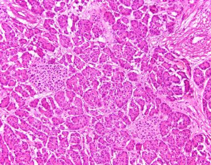 Challenging Issues The presence of pancreatic intraepithelial neoplasia (PanIN) and