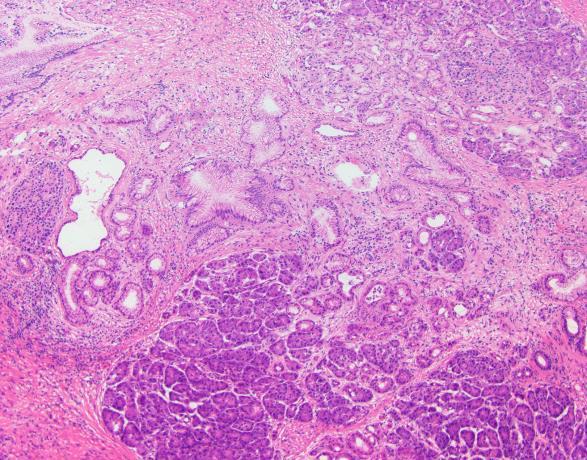 Dysplasia at the bile duct margin Acellular mucin present within the pancreatic