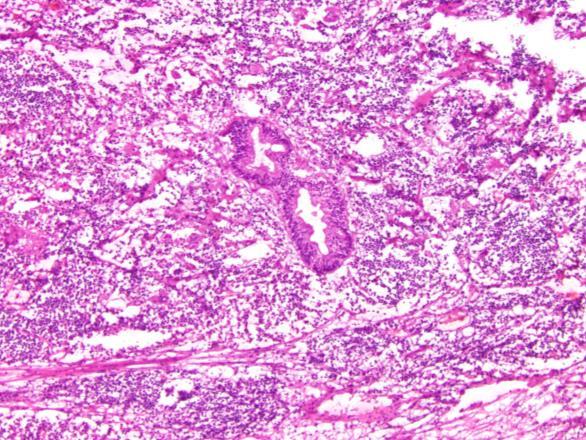 Adenocarcinoma within a Lymph Node at a Margin