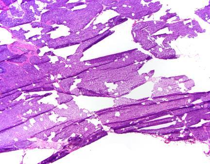 Pancreatic Neck Margins - Artifacts Tissue folding Tissue
