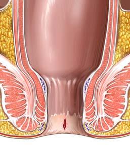 What is an anal fissure? An anal fissure is a tear in the skin around the back passage. It is a common problem that causes severe pain, especially after a bowel movement. It may also cause bleeding.