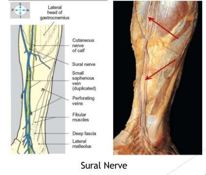 saphenous/sural nerve injury